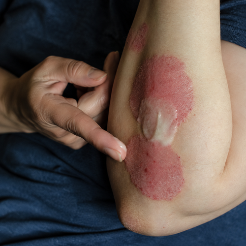 Eczema Skin Procure