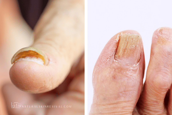 Improvement in nail psoriasis after the fourth injection of... | Download  Scientific Diagram