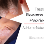 Is it Eczema or Psoriasis? 5 Ways to Stop a Flareup Before They Start