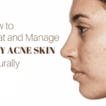 How to Treat and Manage Oily Acne Skin, Naturally