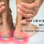 How to Heal Dry Cracked Heels