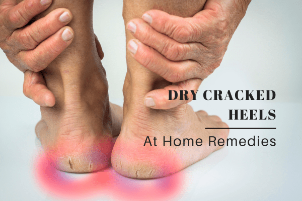 How to Heal Dry Cracked Heels