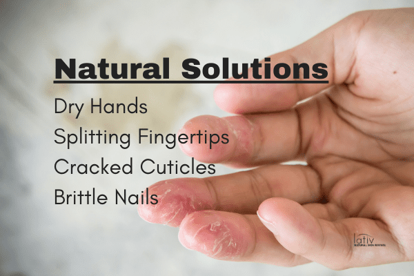 How To Heal Dry Cracked Hands, Fingertips & Cuticles - Natural Skin Revival