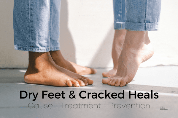 Dry Cracked Heels - Causes, Prevention, Home Remedies and Treatment