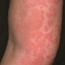 Gluten Rash Adult
