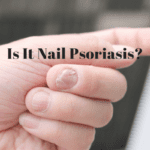 6 Tips on Managing Nail Psoriasis