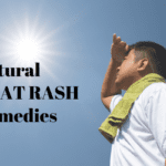 11 Natural Home Remedies To Treat Heat Rash