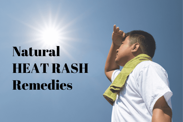 11 Natural Home Remedies To Treat Heat Rash