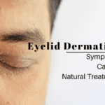 Eyelid Dermatitis Eczema: Symptoms, Cause & Treatment