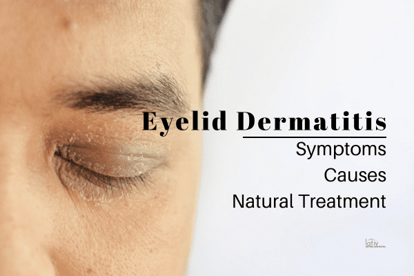 Eyelid Dermatitis Eczema: Symptoms, Cause & Treatment