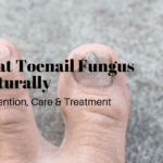 Living With Nail Fungus? Here’s How to Manage & Prevent Recurrence