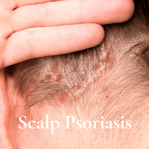 Scalp Psoriasis